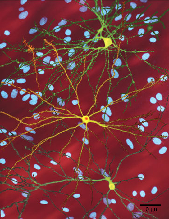 La micrographie montre un neurone présentant des inclusions nucléaires caractéristiques de la maladie de Huntington.