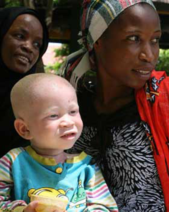 La photo montre un enfant albinos avec sa mère noire.