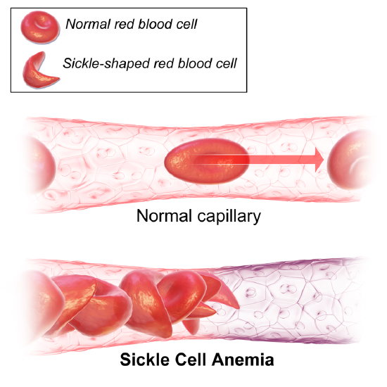 Sickle_Cell_Anemia.png