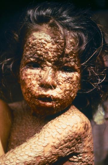 Child with Smallpox in Bangladesh