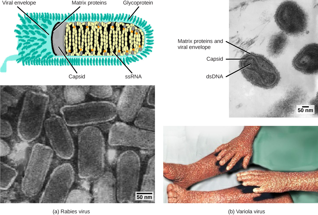 La partie a (en haut) est une illustration du virus de la rage, qui est en forme de balle. L'ARN est enroulé à l'intérieur d'une capside, qui est enfermée dans une enveloppe virale matricielle bordée de protéines et parsemée de glycoprotéines. La partie a (en bas) est une micrographie d'un groupe de virus de la rage en forme de balle. La partie b (en haut) est une micrographie du virus de la variole, dont l'ADN est enfermé dans une capside en forme d'arc. Une enveloppe protéinée à matrice ovale entoure la capside. La partie b (en bas) montre des lésions bosselées et irrégulières sur les bras et les jambes d'une personne atteinte de variole.