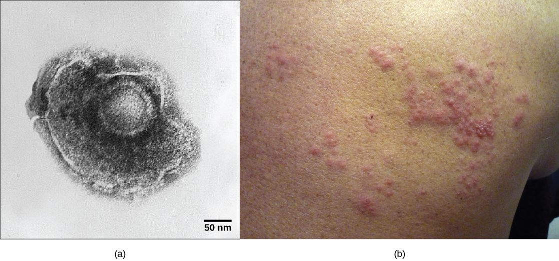 a 部分显示了水痘带状疱疹病毒的显微照片，该病毒的衣壳周围环绕着形状不规则的包膜。 b 部分显示人脸上有红色的颠簸带状疱疹皮疹。