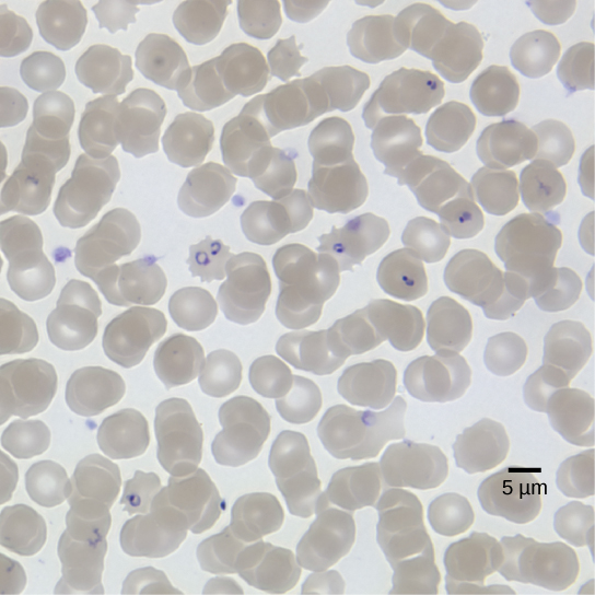 显微照片显示圆形红细胞，每个红细胞的宽度约为8微米，感染了环状恶性疟原虫。