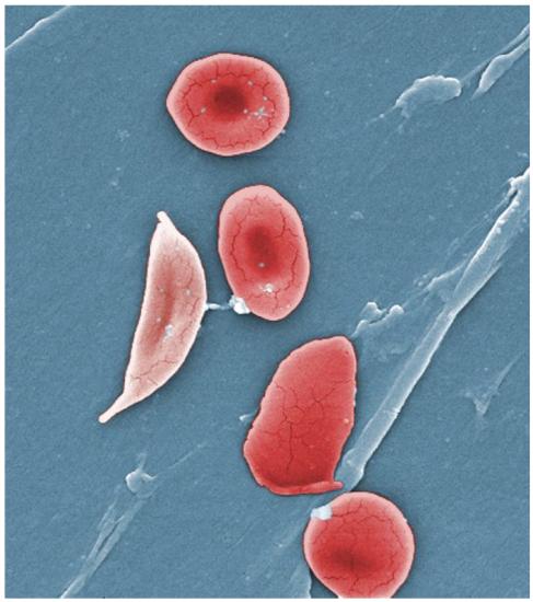 Sickle cell Anemia RBC