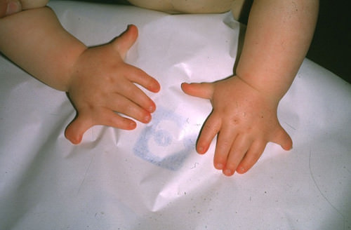 Polydactyly, a child with more than 5 fingers 