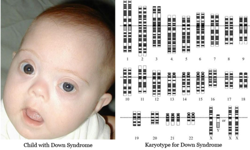 Brushfield eyed child and Karyotype of Down syndrome 