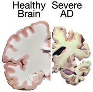 healthy brain versus Alzheimer's disease brain