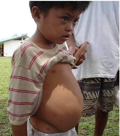 Schistosomiasis in a child 