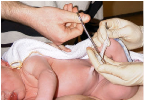 umbilical cord being cut