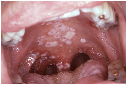 Candidiasis in mouth