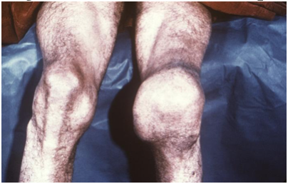 Charcot joint tertiary syphilis