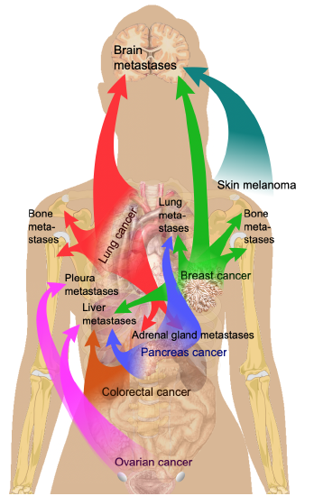 Metastasis sites for common cancers
