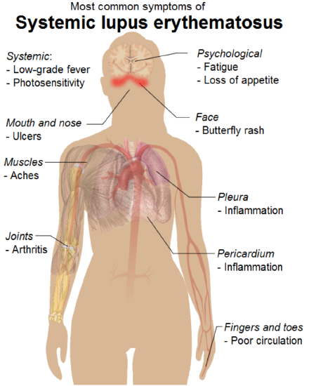 Symptoms of SLE