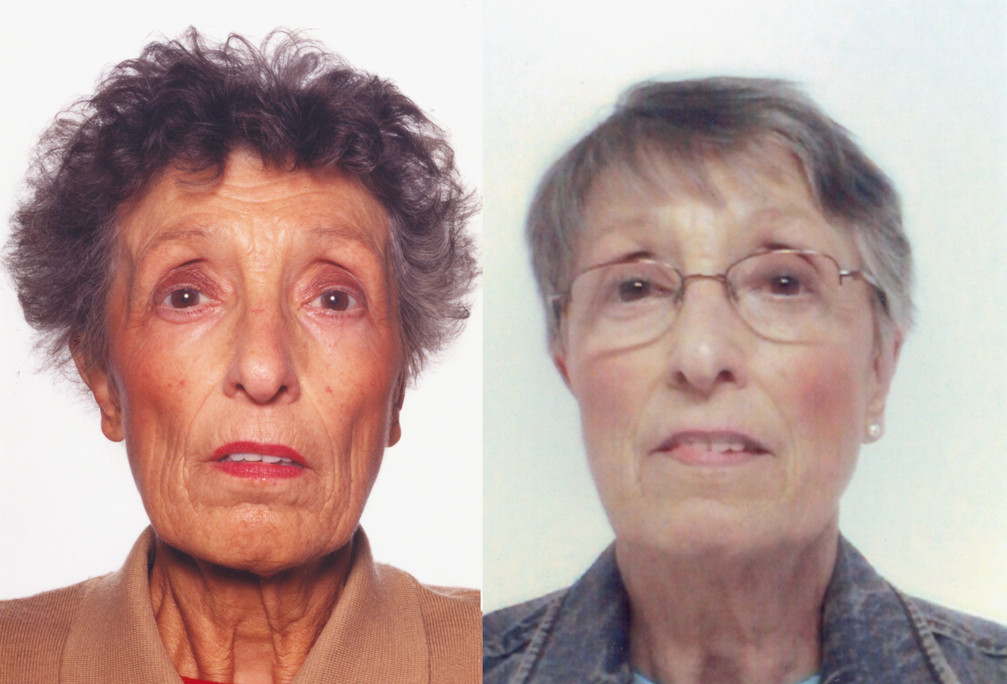 A 69-Year-Old Female with Tiredness and a Persistent Tan