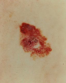 Melanoma, red and brown lesion