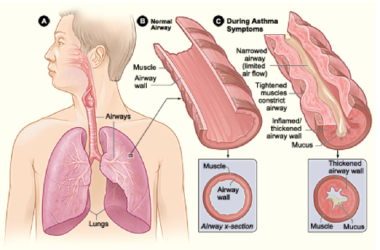 Asthma attack-illustration 