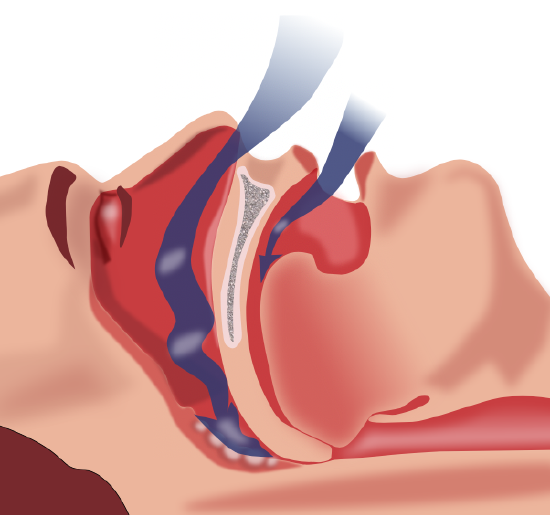 Obstruction ventilation sleep apnea