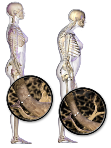 Osteoporosis humpback