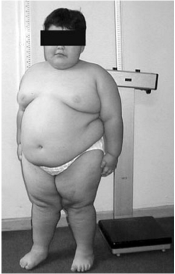 super obese eight years old boy