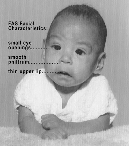 Photo of baby with FAS