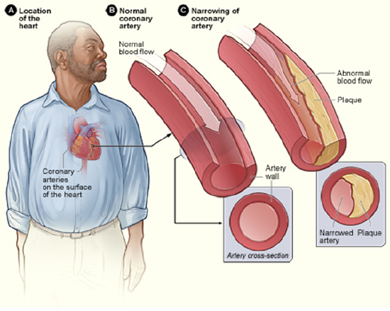 Coronary heart disease-atherosclerosis