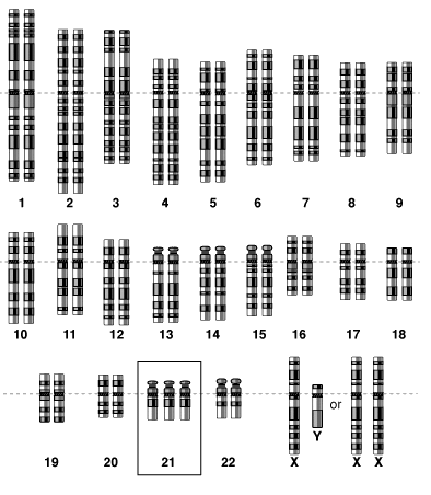 trisomy 2 Karyotype