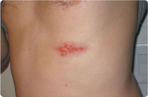 Shingles is caused by the same virus that causes chicken pox
