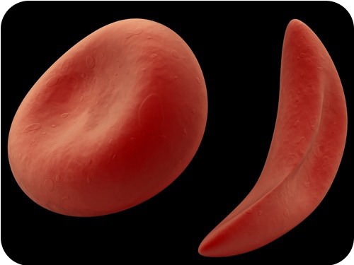 Sickle-cell anemia blood cells, and normal red blood cell