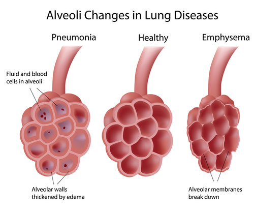 Alveoli: healthy, pneumonia, and emphysema.