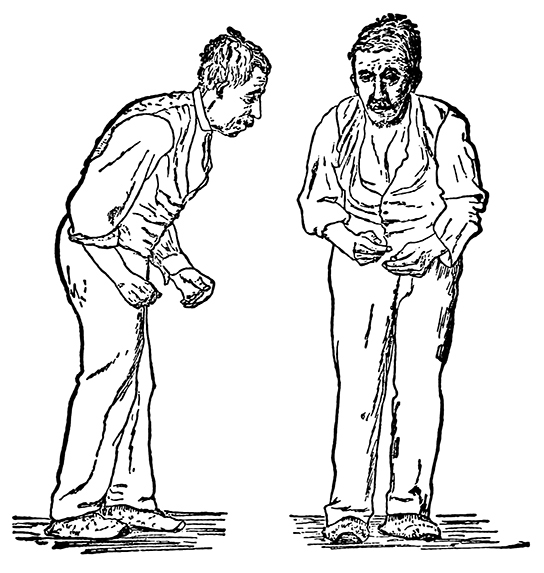 插图显示了一个弯腰的人，手臂僵硬，正在洗牌走路。