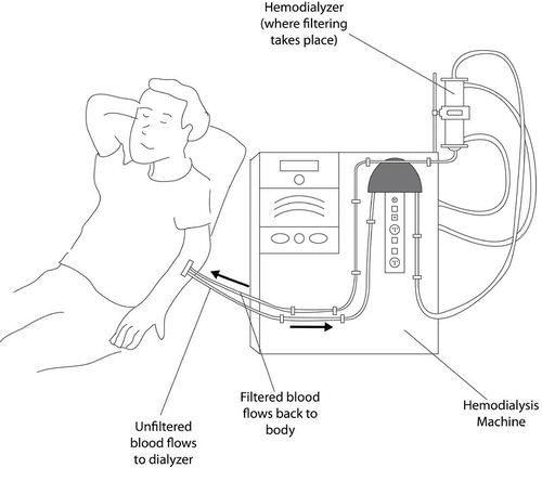 Dialysis machine illustration