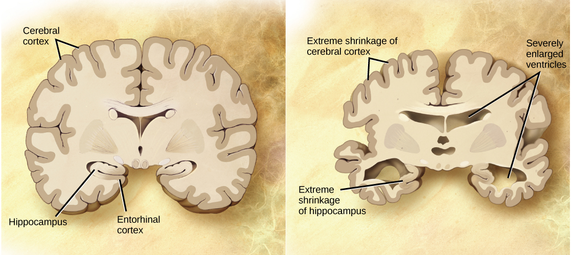 比较了正常大脑和阿尔茨海默病患者大脑的横截面。 在阿尔茨海默氏症的大脑中，大脑皮层的大小大大缩小了，海马体也是如此。 心室，大脑中部、右下角和左下角的洞，也有所扩大。