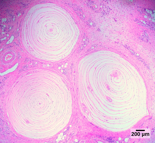 La micrographie montre trois corpuscules de Pacini intégrés dans le derme. Les corpuscules sont ronds et mesurent environ 1,4 millimètre de diamètre et ont des anneaux, comme une souche d'arbre.