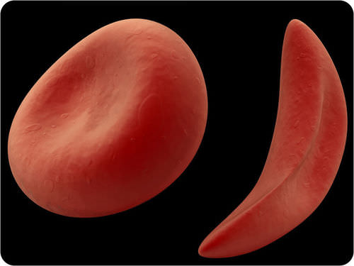 Sickle cell anemia and normal red blood cells