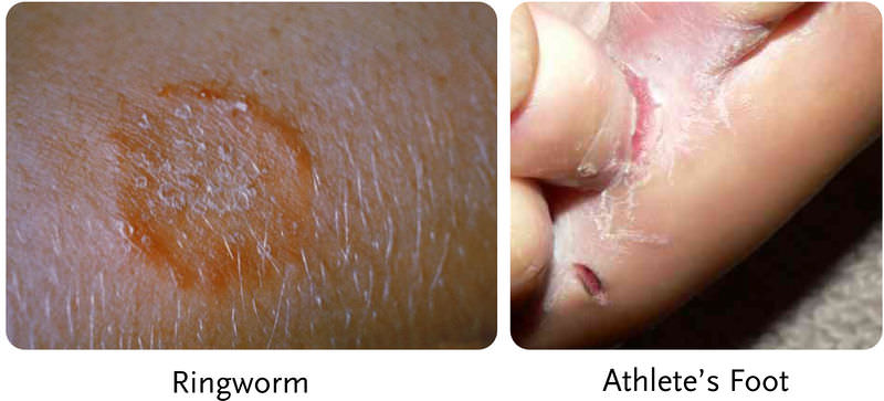 Ringworm and athlete's foot are fungal diseases
