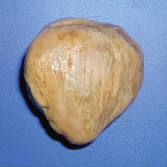 La rotule est un os plat en forme de larme.