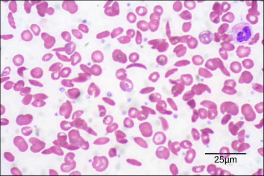 La micrographie montre un frottis de globules rouges ; certains sont en forme de disque et comprimés au centre, tandis que d'autres sont en forme de croissant. Chaque globule rouge mesure environ cinq microns de diamètre.