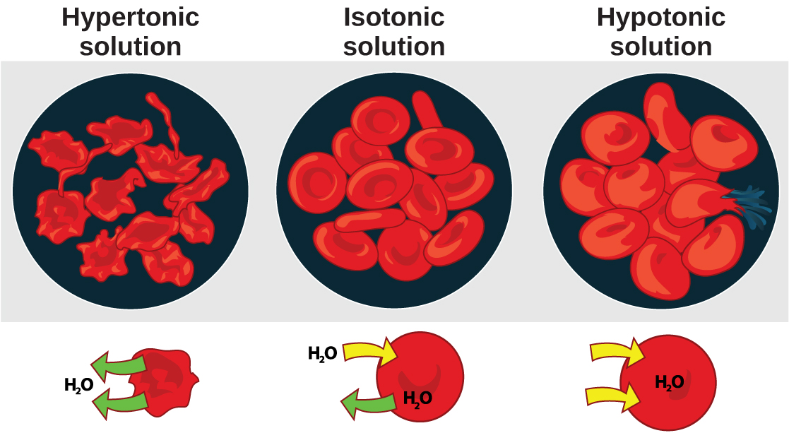 La parte izquierda de esta ilustración muestra glóbulos rojos arrugada bañados en una solución hipertónica. La parte media muestra glóbulos rojos sanos bañados en una solución isotónica, y la parte derecha muestra glóbulos rojos hinchados bañados en una solución hipotónica. Una de las células hinchadas en la solución hipotónica estalla.