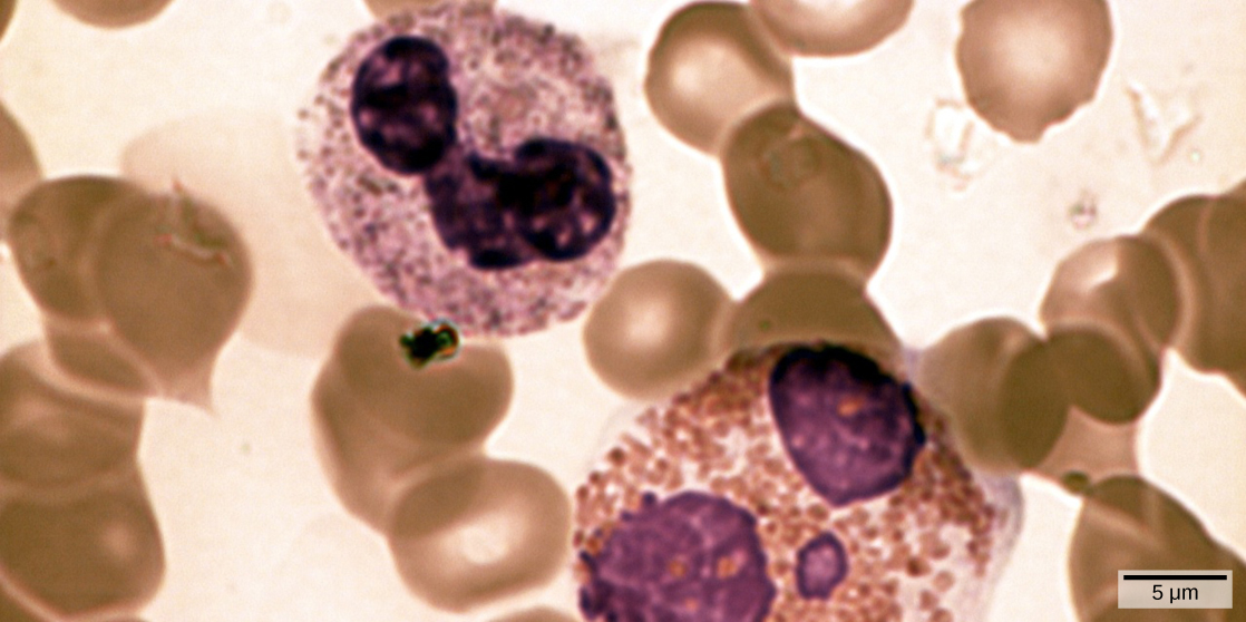 صورة مجهرية تظهر مسحة دم. تتشابه العدلات والحمضات في التركيب، لكن اليوزينوفيل أكبر. كلاهما مملوء بالهياكل الحبيبية، ولديهما ثلاث نوى ملطخة باللون الأرجواني. خلايا الدم البيضاء هذه محاطة بخلايا دم حمراء على شكل دونات.