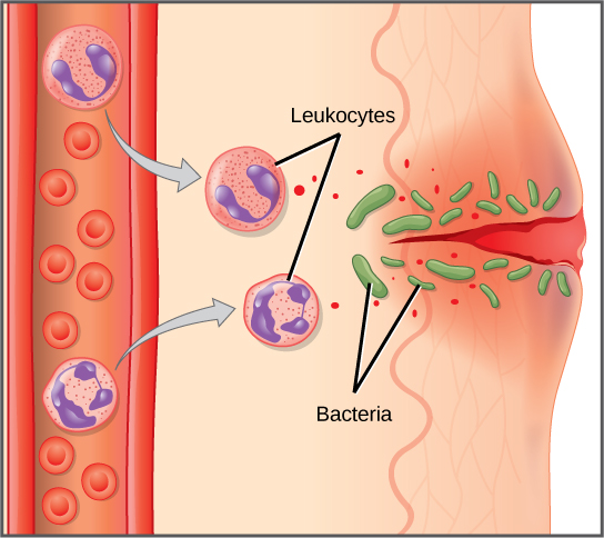 L'illustration montre un capillaire près de la surface de la peau qui présente une coupure. Des bactéries ont pénétré la peau autour de la coupure. En réponse, les cellules de masse de la partie inférieure du tissu cutané libèrent des histamines et les cellules dendritiques libèrent des cytokines. Les histamines rendent le capillaire perméable. Les neutrophiles et les monocytes sortent du capillaire pour pénétrer dans la peau endommagée. Le neutrophile et le macrophage libèrent des cytokines et consomment des bactéries par phagocytose.