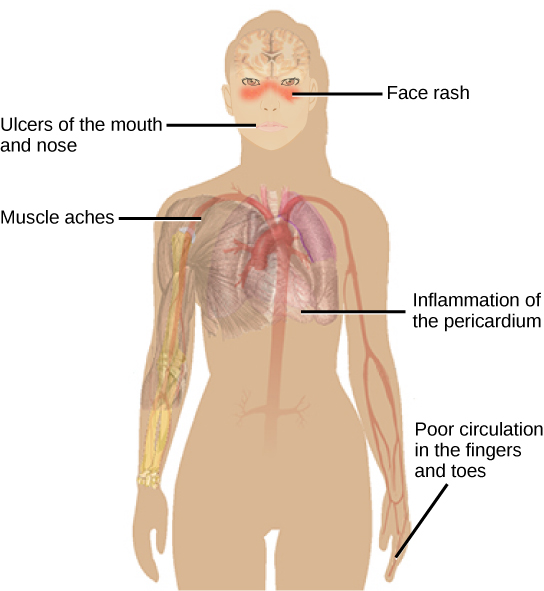 A ilustração mostra os sintomas do lúpus, que incluem erupções na face, úlceras na boca e no nariz, inflamação do pericárdio e má circulação nos dedos das mãos e dos pés.