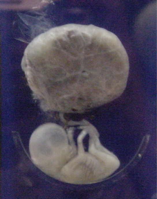 O feto do segundo trimestre tem braços e pernas longos e está preso à placenta, que é redonda e maior que o feto.
