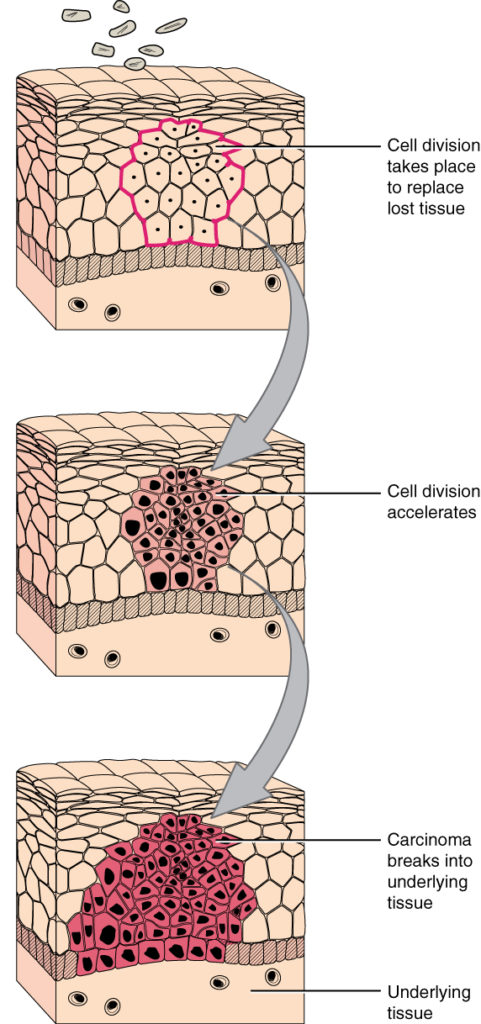 This series of three diagrams shows the development of cancer in epithelial cells. In all three diagrams, layers of epithelial tissue cover a generic underlying tissue. In the first diagram, an injury kills a section of the epithelial cells. In the second image, new epithelial cells have completely filled in the wounded area. However, cell division is still accelerating. In the lowest diagram, the epithelial cells have continued to divide and have now expanded beyond the original wound area. The group of dividing cells, now called a carcinoma, breaks into the layer of underlying tissue.