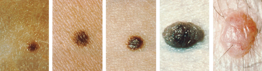 Five photos of moles. The three upper photos show moles that are small, flat, and dark brown. The bottom left photo shows a dark black mole that is raised above the skin. The bottom right photo shows a large, raised, reddish mole with protruding hairs.