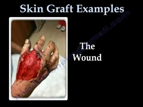 Thumbnail for the embedded element "SKIN GRAFT . EVERYTHING YOU NEED TO KNOW - DR. NABIL EBRAHEIM"