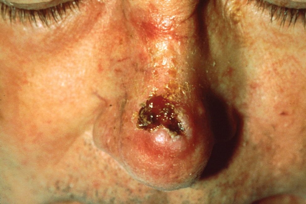 This photo shows a man’s nose. The squamous cell carcinoma is located just above the tip of the nose and appears as a deep red, irregularly-shaped sore that spans almost the entire bridge of his nose.