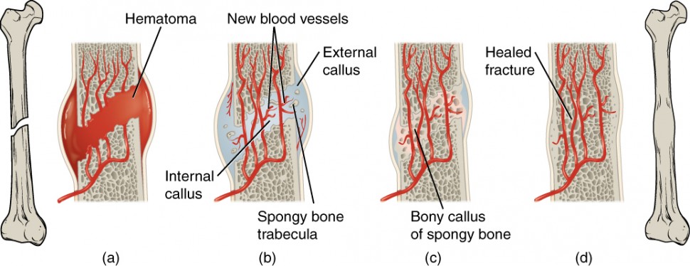 This illustration shows a left to right progression of bone repair. The break is shown in the leftmost image, where the femur has an oblique, closed fracture in the middle of its shaft. The next image magnifies the break, showing that blood has filled the area between the broken bones. Blood has also filled in around the lateral and medial sides of the break. The influx of blood causes the broken area to swell, creating a hematoma. In the next image, the hematoma has been replaced with an external callus between the two broken ends. Within the internal callus, the blood vessels have reconnected and some spongy bone has regenerated in the gap between the two bone halves. In the next image, spongy bone has completely regenerated, connecting the two broken ends, referred to as the bony callus. The external callus still remains on the lateral and medial sides of the break, as the compact bone has not yet regenerated. In the final image, the compact bone has fully regenerated, encapsulating the bony callus and completely reconnecting the two bone halves. The bone has a slight bulge at the location of the healed fracture, which is clearly shown in the final image, which shows a zoomed out image of the completely healed femur.