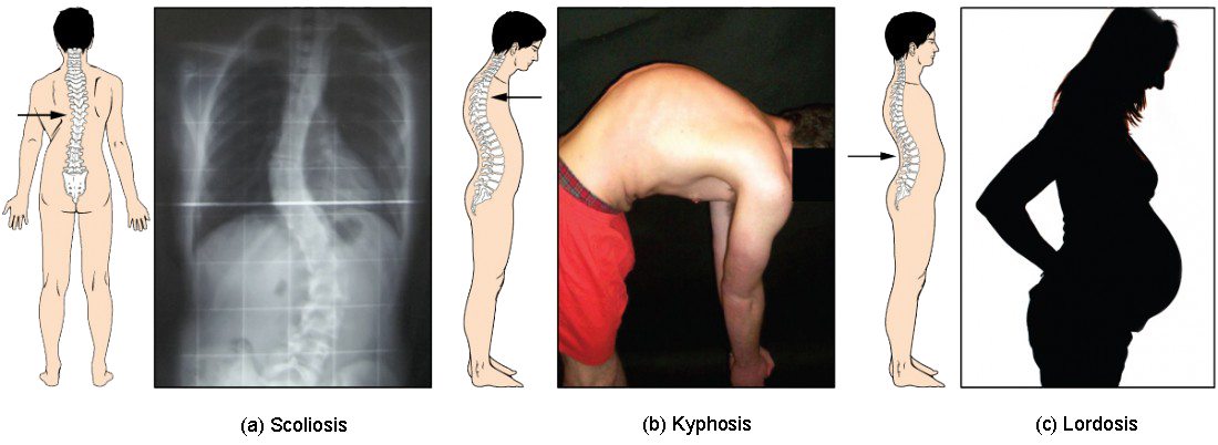 This image shows the changes to the abnormal curves of the vertebral columns in different diseases. The left panel shows the change in the curve of the vertebral column in scoliosis, the middle panel shows the change in the curve of the vertebral column in kyphosis, and the right panel shows the change in the curve of the vertebral column in lordosis.