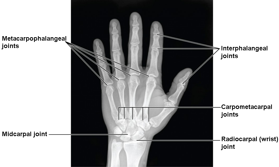 This image shows a radiograph of a human hand.