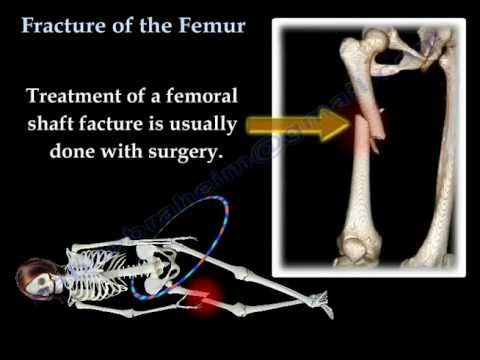 Thumbnail for the embedded element "Fracture of the Femur and its fixation - Everything You Need To Know - Dr. Nabil Ebraheim"